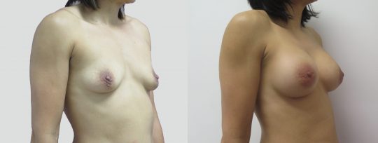 Case #94 Submuscular inframammary breast augmentation