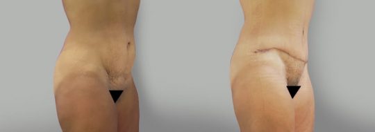 Case #21 Abdominoplasty, loose abdominal skin prior to the procedure