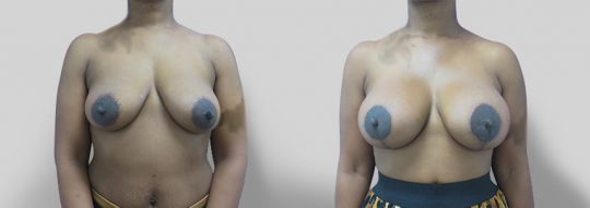front view of a female patient before and after Submuscular inframammary breast augmentation