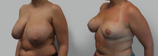 Case #27 Breast Reduction