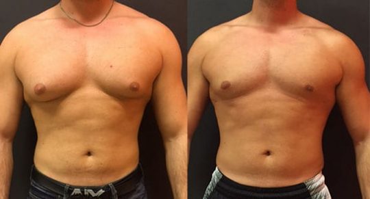 front view of a male patient before and after Gynecomastia Reduction