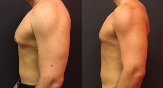 side view of a male patient before and after Gynecomastia Reduction