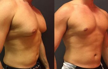 side view of a male patient before and after Gynecomastia Reduction