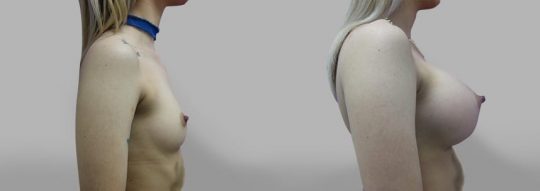 side view of a female patient before and after Submuscular inframammary breast augmentation