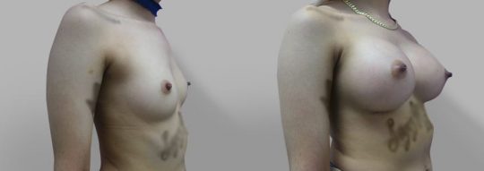 Case #47 Submuscular inframammary breast augmentation