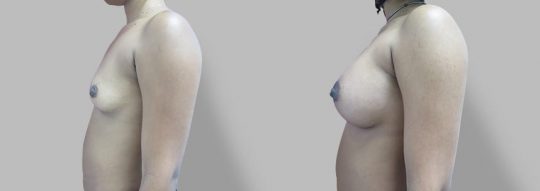 Case #60 Submuscular inframammary breast augmentation