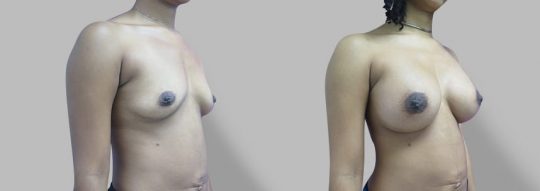 Case #60 Submuscular inframammary breast augmentation