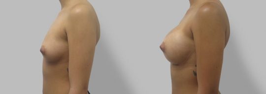 Case #61 Submuscular inframammary breast augmentation