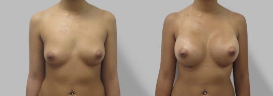 front view of a female patient before and after Submuscular inframammary breast augmentation