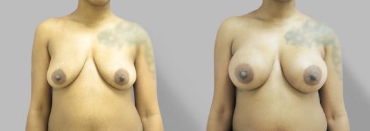 front view of a female patient before and after Subglandular inframammary breast augmentation