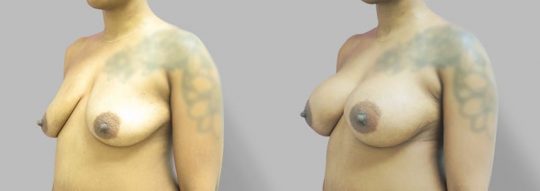 Case #63 Subglandular inframammary breast augmentation