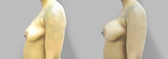 side view of a female patient before and after Subglandular inframammary breast augmentation