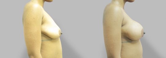 side view of a female patient before and after Subglandular inframammary breast augmentation