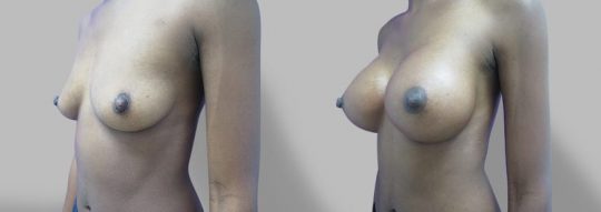 side view of a female patient before and after Submuscular inframammary breast augmentation