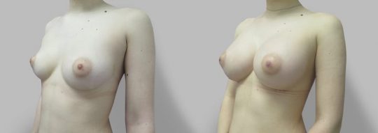 Case #68 Breast augmentation
