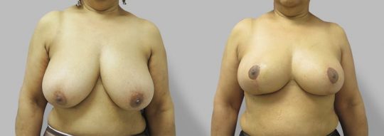 Case #69 Breast Reduction