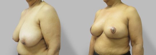 Case #69 Breast Reduction