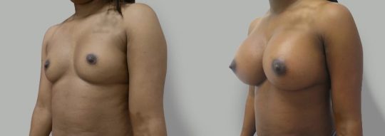 Case #20 Submuscular inframammary breast augmentation