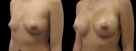 Case #133 Breast augmentation