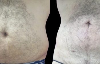 front view of a male patient before and after Liposuction of abdomen and flanks