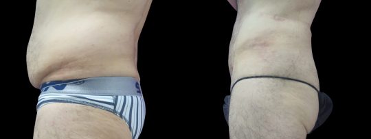 side view of a male patient before and after Liposuction of abdomen and flanks