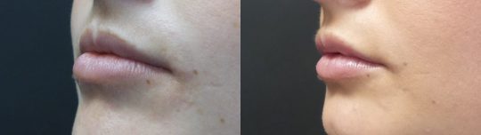 female patient before and after JUVÉDERM VOLBELLA® XC injection