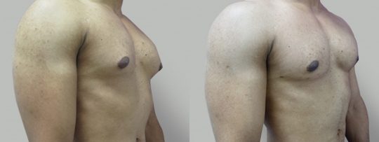 side view of a male patient before and after Gynecomastia Reduction