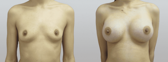 front view of a female patient before and after Breast augmentation