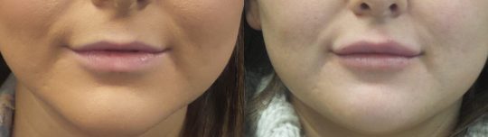 female patient before and after Lip Injections