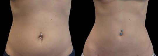 Case #89 Liposuction