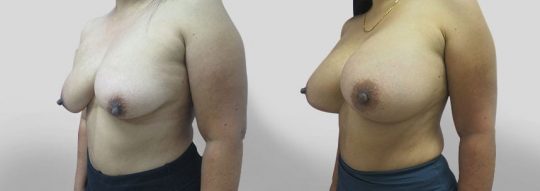Case #31 Breast augmentation
