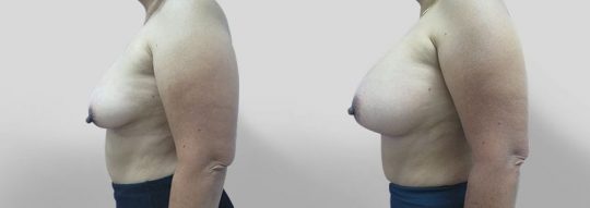 side view of a female patient before and after Breast augmentation