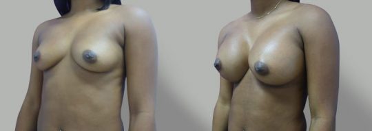 Case #36 Breast augmentation