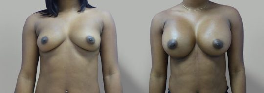 Case #36 Breast augmentation