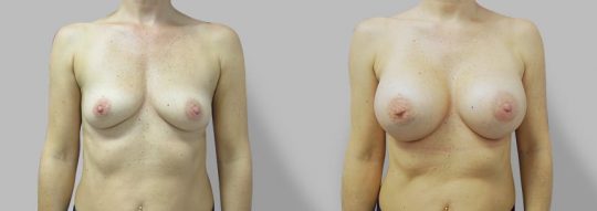 Case #62 Breast augmentation