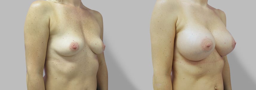 Procedure: Breast Augmentation with high profile 500 CC silicone gel implan...