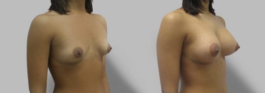 Case #77 Breast augmentation