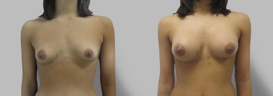 Case #77 Breast augmentation