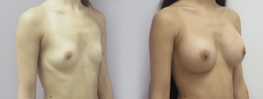 female patient before and after Breast augmentation