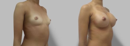 Case #79 Breast augmentation