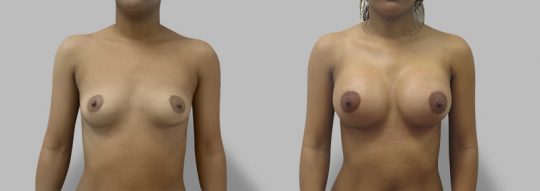 Case #83 Breast augmentation