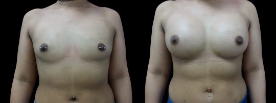 Case #95 Breast augmentation