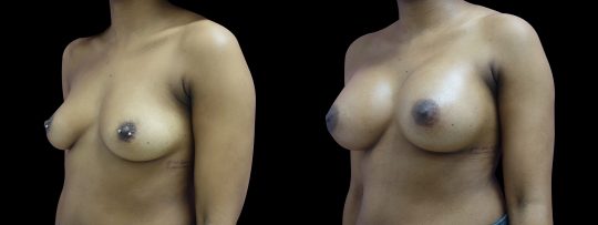 Case #105 Breast augmentation