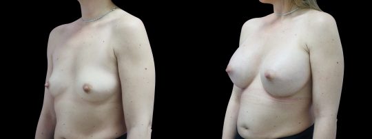 Case #109 Breast augmentation