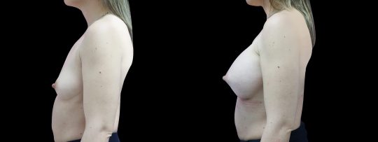 Case #109 Breast augmentation