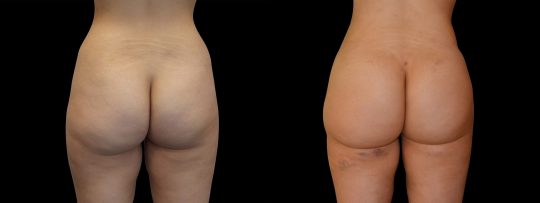 a female patient before and after Brazilian Butt Lift