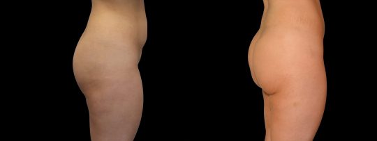 side view of a female patient before and after Brazilian Butt Lift