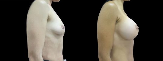Case #126 Breast augmentation