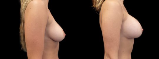 Case #127 Breast augmentation