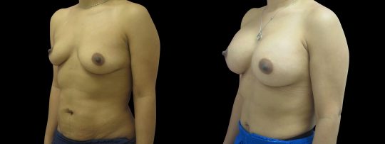 side view of a female patient before and after Breast augmentation